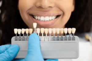 Dental veneers