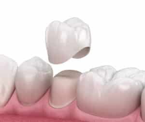 Closeup graphic of a dental crown being placed in mouth