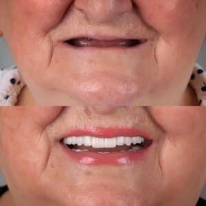 Woman before and after full-mouth dental implants